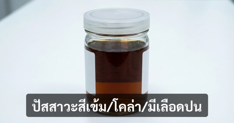 ปัสสาวะสีเข้ม/โคล่า/มีเลือดปน บอกอะไรเกี่ยวกับสุขภาพไต (เช็คด่วนก่อนสาย)