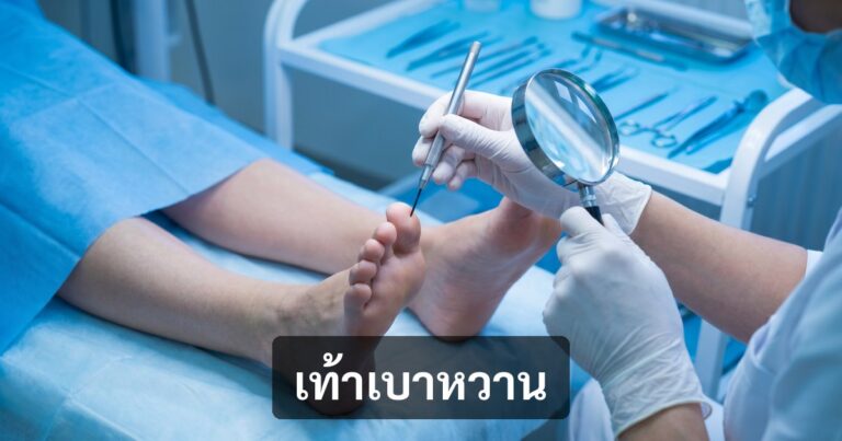 แผลเบาหวานที่เท้า (Diabetic Foot) — 7 สัญญาณเตือน + วิธีป้องกันก่อนต้องตัดขา
