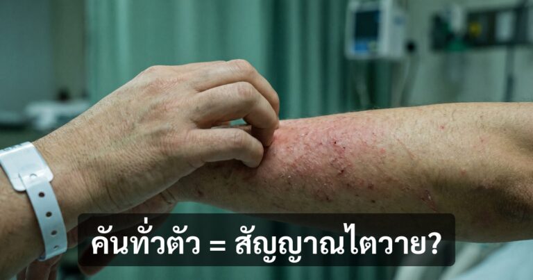 คันทั่วตัวจากโรคไต (Uremic Pruritus) — สาเหตุและ 6 วิธีบรรเทา